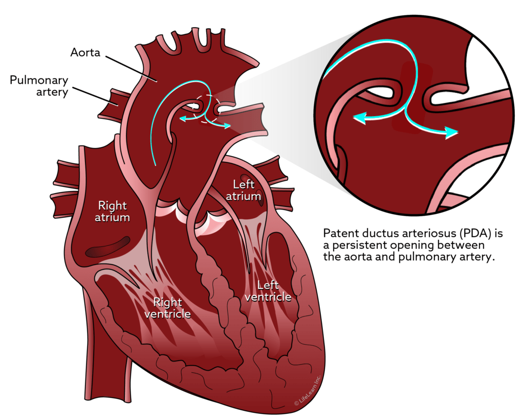 <p>Patent ductus arteriosus (PDA)</p>
