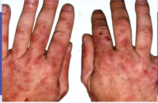 <p>What are some examples of cutaneous symptoms </p>