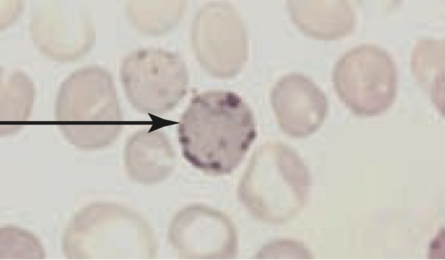 <p>5th stage of erythrocyte formation</p><ul><li><p><strong>diameter:</strong> 7-10 micrometers</p></li><li><p><strong>cytoplasm:</strong></p><ul><li><p>blueish tint and slightly larger than RBCs</p></li></ul></li><li><p>contain residual RNA but no nucleus → <strong>bluish tinge w/ Romanowsky stains</strong> (supravital stains - new methylene blue-N)</p></li><li><p>when nucleus is first ejected, the cell has irregular lobe shape</p></li><li><p>when remaining 20% of cell’s Hb is made</p></li><li><p>react w/ these stains to produce precipitation of RNA + mitochondria</p><ul><li><p>supravital stains = purplish-blue inclusions spread out</p></li><li><p>new methylene blue N</p></li><li><p>brilliant cresyl blue</p></li></ul></li><li><p>released in 2-3 days and circulates for 1-2 before maturing</p></li><li><p>ribosomes disappear as cell matures to carry more Hb</p></li><li><p>granular filamentous ribosomes</p></li></ul><img src="https://assets.knowt.com/user-attachments/d7e64620-3f4b-4418-a974-2e2f4ed7e303.png" data-width="100%" data-align="center"><p></p>