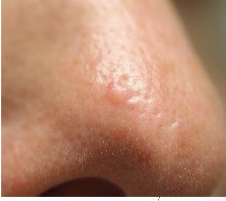 <p>Basal Cell Carcinoma (BCC): pearly pink plaque w/ central depression and TELANGIESTASIAS</p><p>MIMIC: Fibrous Papule</p><ul><li><p>skin-colored NO telangeictasias</p></li><li><p>may become excoriated (loss of skin’s surface)</p></li></ul><p></p>