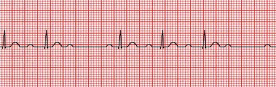 <p>the image shown depicts what cardiac arrhythmia?</p>
