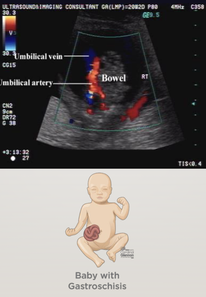 <ul><li><p>“loose bowel pooching out—floating outside abdomen” </p></li></ul><p></p>
