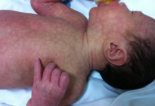 <p>lacey look on infants</p><ul><li><p>due to dilated blood vessels and immature circulation</p></li><li><p></p></li></ul><p></p>