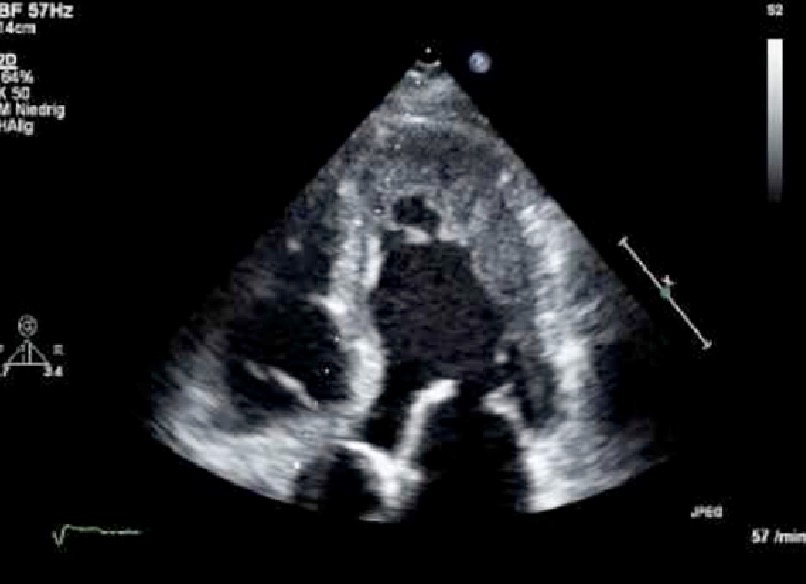 <p>What pathology does this echo look like?</p><ul><li><p>Hypokinesis and myocardial thickening localized in apex</p></li></ul><p></p>