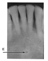 <p>Radiolucent dot inside genial tubercles</p>