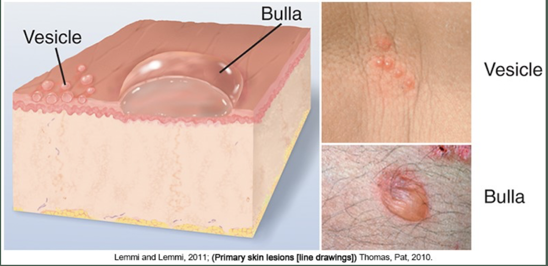 <p>larger than 1 cm, usually single chamber, superficial in dermis and ruptures easily</p>
