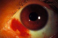 <p>Focal, red region on the ocular surface</p><p>May be caused by trauma, contact lens use, elevated venous pressure, hypertension, coagulopathy</p>