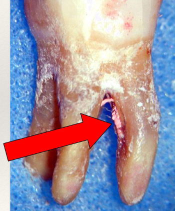 <p>Strip perforations- a <span>severe breakdown of the dentinal wall caused by over-instrumentation or excessive shaping in curved or thin canals</span></p>