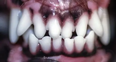 <p>Which class of malocclusion describes a mandibular tooth has a more buccal(cheek) or labial(lip) position than the antagonist maxillary tooth?</p>