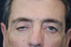 <p>myasthenia gravis</p>