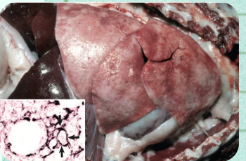 <p>What metabolic lung disorder can result from hypercalcemic states or chronic diseases, causing the tissue to develop a "gritty" texture and fail to collapse when the thoracic cavity is opened?</p>