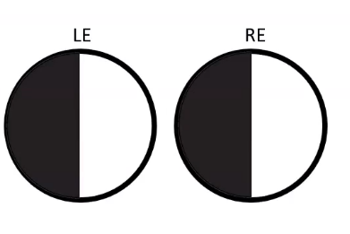 <p>anatomy of the field plot in visual pathway </p>