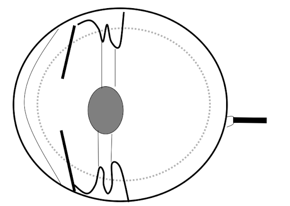 <ul><li><p>Accumulation of aqueous humor</p></li><li><p>Causes increased intraocular pressure</p></li></ul><p></p>
