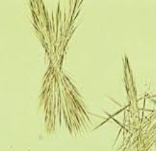 <p>Colorless-brown fine needles (Pine needles)<br>Abnormal, Seen with liver disease</p>
