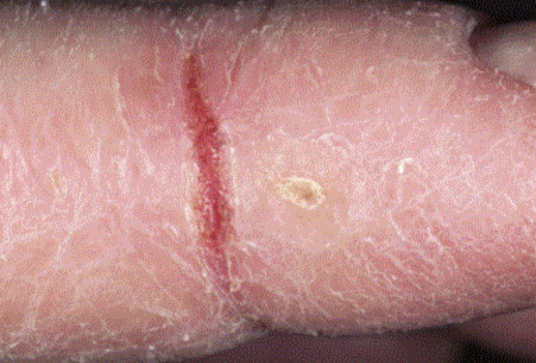<p>Secondary lesion - fissure </p>