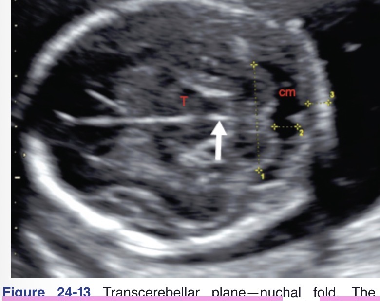 <p>TCD= gestational week of fetus</p><p>Measured at transverse plane at level of cisterna magna and thalamus </p>