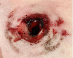 <p></p><p>Questions</p><ol><li><p>What is the specimen being examined?</p></li><li><p>What are the specific descriptive features of the wound edges and diameter?</p></li><li><p>What specific finding proves a contact range of firing, and what form does it take?</p></li><li><p>How is the antemortem nature of this injury determined?</p></li><li><p>What type of causative instrument and firing pattern produced this injury?</p></li><li><p>How is the time of death estimated?</p></li><li><p>What are the possible causes of death?</p></li><li><p>What is the final diagnosis?</p></li></ol><div data-type="horizontalRule"><hr></div><p></p>