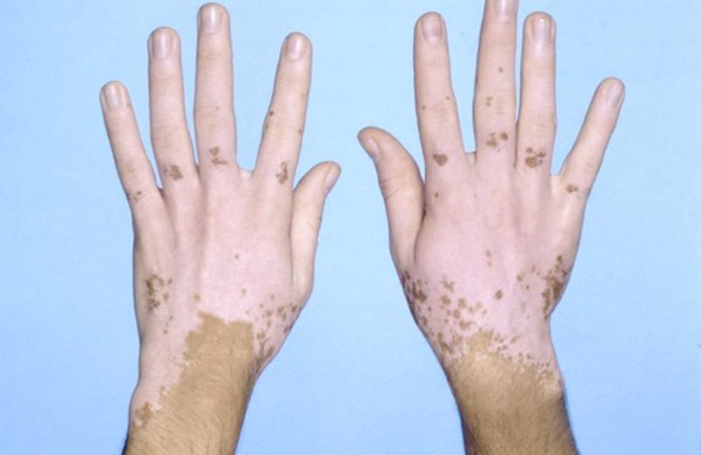 <p>localized loss of skin pigmentation characterized by milk-white patches</p>