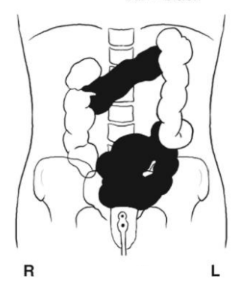 <p>What position is the patient in? Air = black. Barium = white</p>