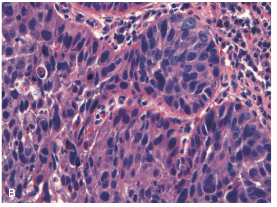 <p>diagnosis, esophageal tumor</p>
