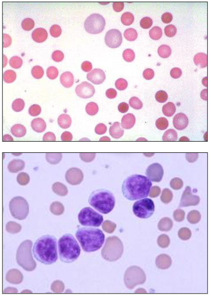 <p>Haematology of AIHA</p><p>- Spherocytes: no central pallor due to loss of membrane; small and dark Hb</p><p>- Polychromasia (increased reticulocytes)</p><p>- Nucleated red cells: (BM response to anaemia)</p><p>- Underlying disease (e.g leukaemia)</p>