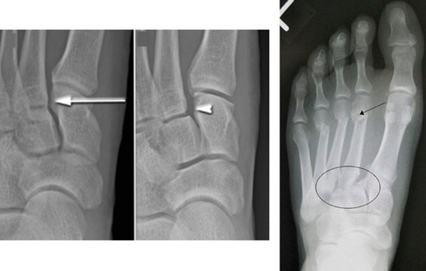 <p>extremely subtle; located medial cuneiform of 2nd metatarsal</p><p>*failure to catch can cause M2-M4 to shift laterally</p>