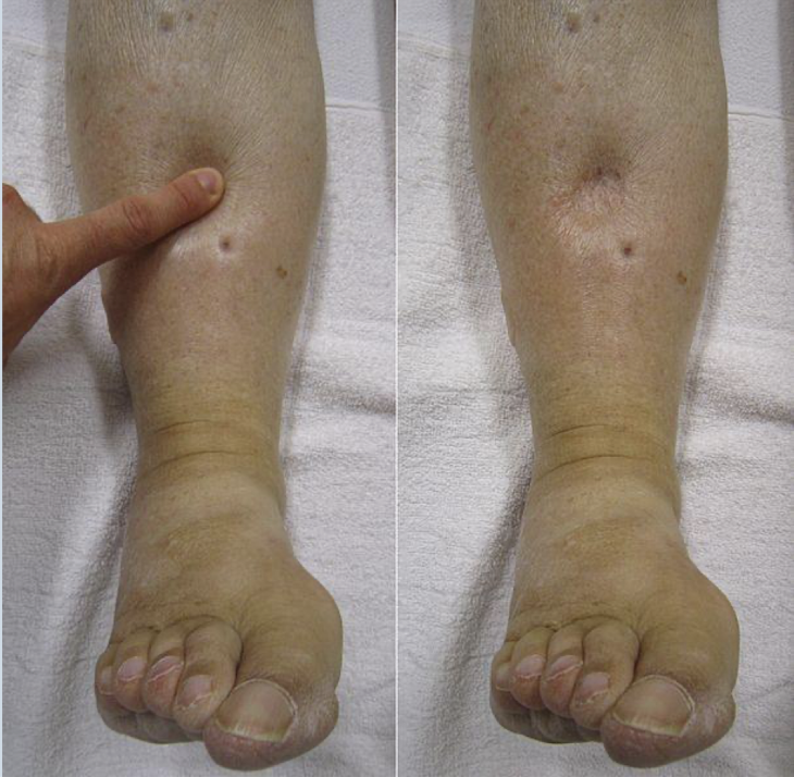 <p>Edema</p>