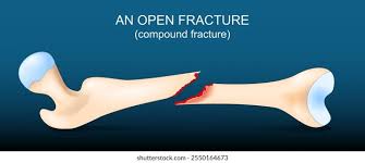<p>What is an open (compound) fracture?</p>
