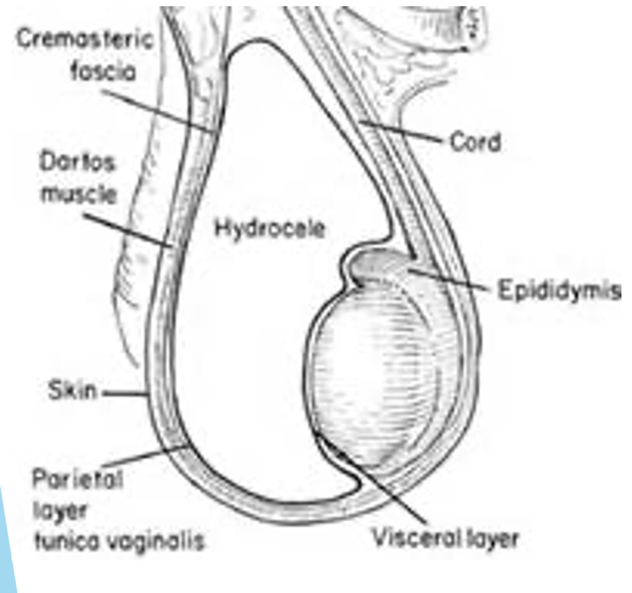 <p>Collection of fluid around the testicle, forming between the parietal tunica vaginalis and the visceral tunica vaginalis</p>
