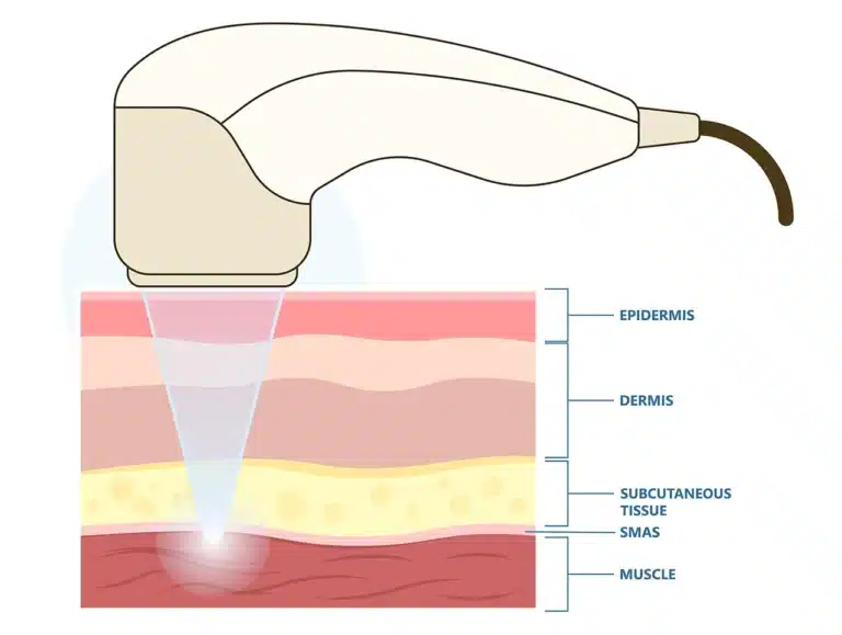 <p>Superficial musculo-aponeurotic system</p>
