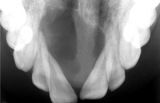 <p>central giant cell granuloma maxillary occlusal radiograph</p>