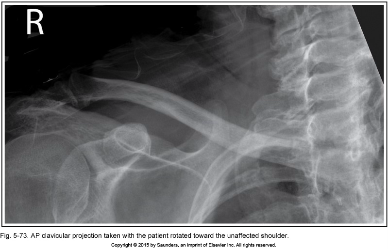 <p>AP clavicle</p>