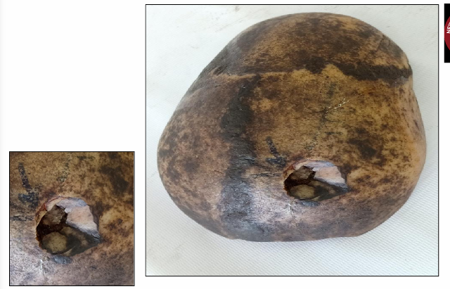 <p>Questions</p><ol><li><p>What is the specimen being examined?</p></li><li><p>What are the type and specific descriptive features of the fracture, including its directional depth indicators?</p></li><li><p>What type of causative instrument and force mechanics produce this injury?</p></li><li><p>How is the time of death estimated?</p></li><li><p>What are the possible causes of death?</p></li><li><p>What is the final diagnosis for this specimen?</p></li></ol><div data-type="horizontalRule"><hr></div><p></p>