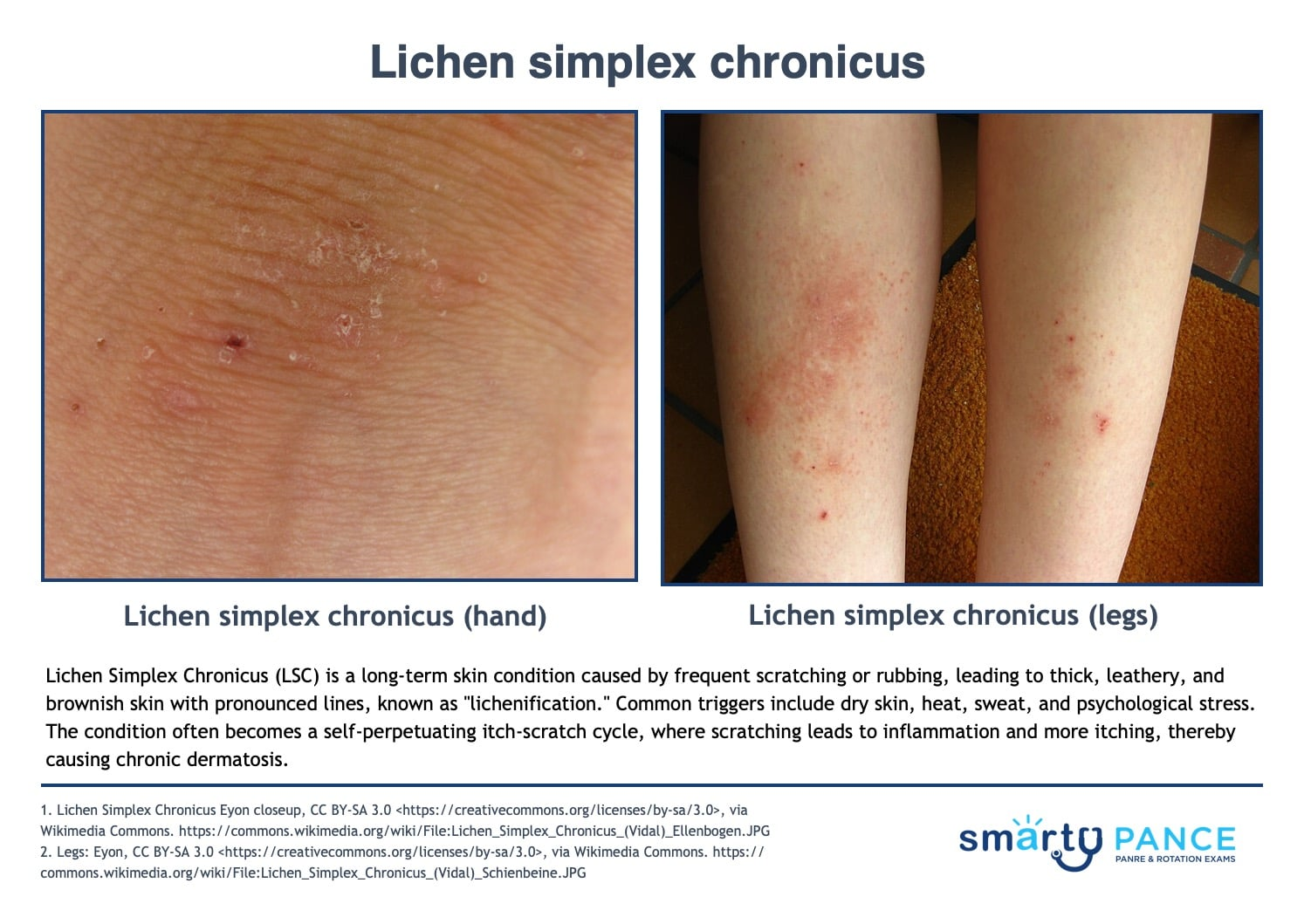 <p>“The rash you scratch into existence”</p><p>-Presentation: thick, leathery, brownish skin in the posterior neck, wrists, ankles, genitals, or lower legs due to repeated scratching and rubbing </p><p>-Dx: clinical </p><p>-Tx: break the itch-scratch cycle, high-potency topical corticosteroids </p>
