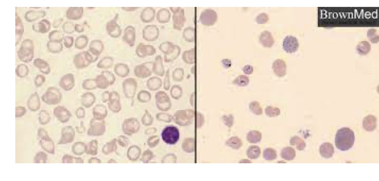 <p>What is alpha thalassemia</p>