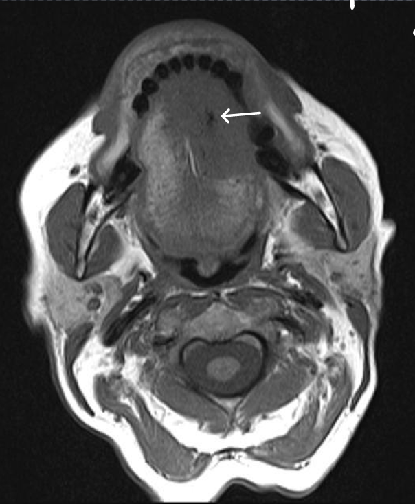 <p>*is this T1 or T2 image, and what is the white arrow pointing to?</p>