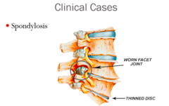 <p>central cord syndrome</p>
