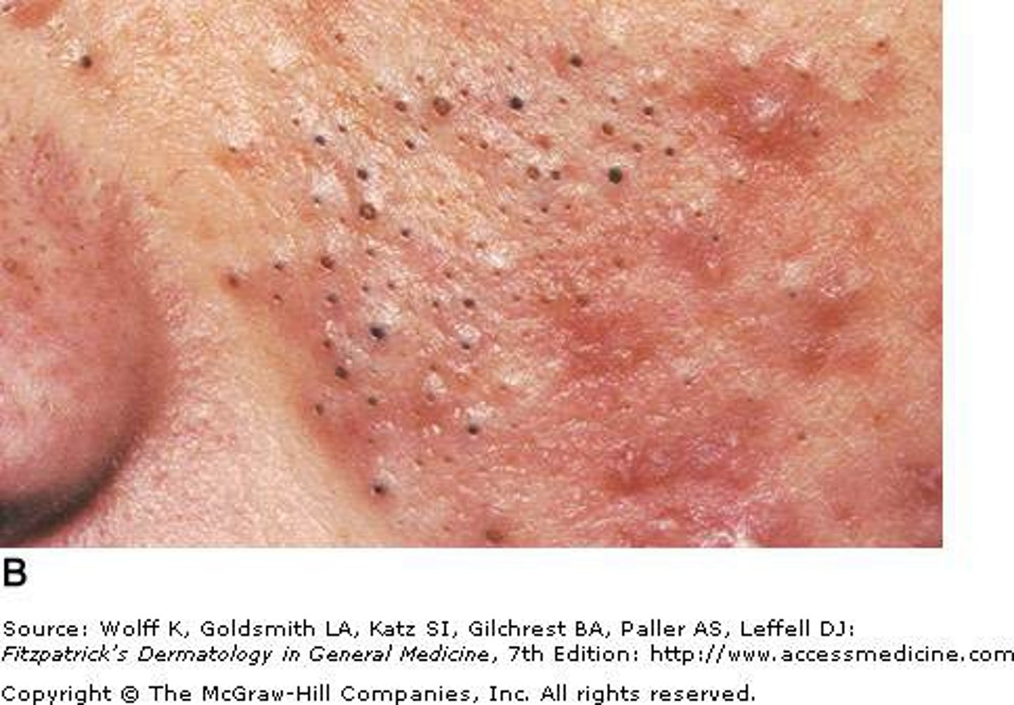 <p>comedones, Also known as a blackhead; hair follicle filled with keratin and sebum.</p>