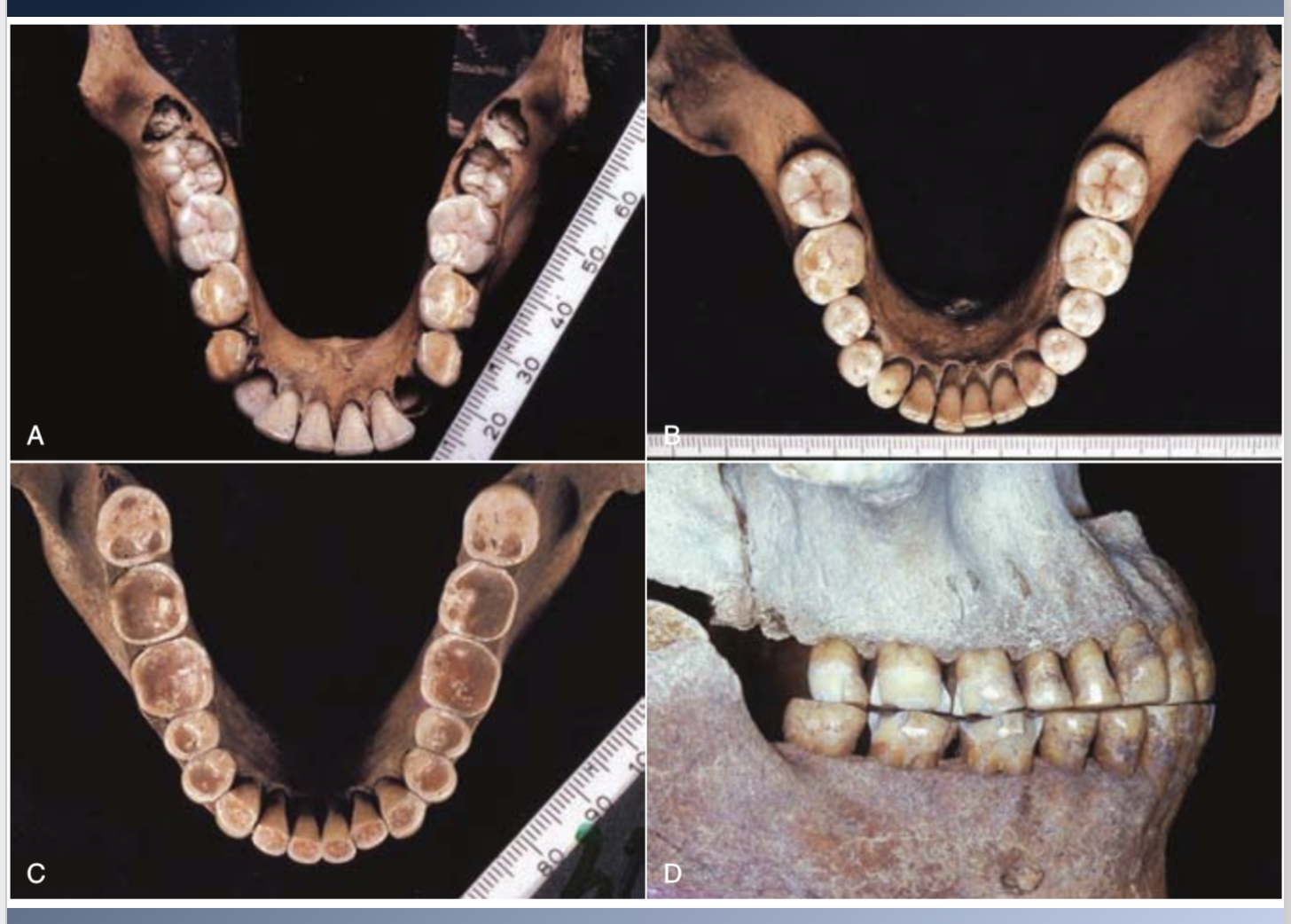 <p><span>1. Primitive populations tend to have a much smaller prevalence of malocclusions.</span><br><span>2. Shortening of arch length and mesial migration of permanent molars à NATURAL PHENOMENON à Crowding</span></p>