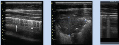 <p>A 2 month old foal presents with focal areas of consolidation that look like comet tails on ultrasound and extra-pulmonary lesions. Thoughts?</p>