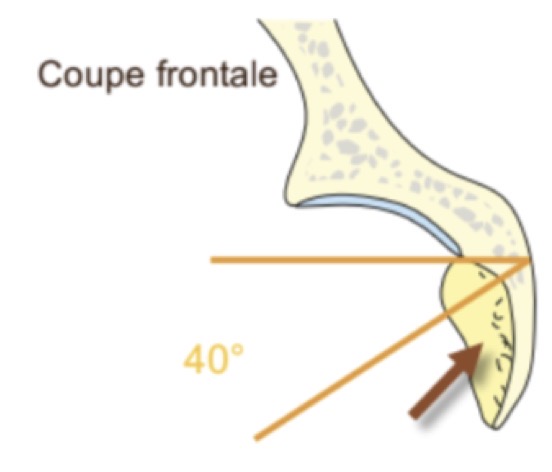 <p>FAUX :</p><ul><li><p>40° vers le bas</p></li><li><p>15° en avant</p></li><li><p>Angle de couverture = surface de glène qui couvre tête fémorale = 30°</p></li><li><p>Angle acétabulaire = profondeur de l’acétabulum = 10°</p></li></ul><p></p>