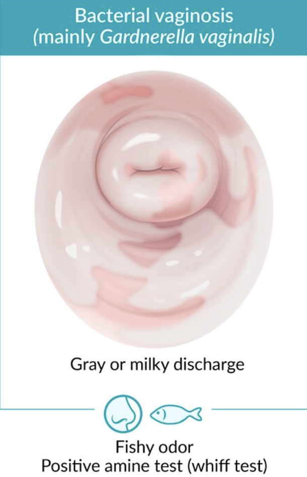 <p>Asymptomatic</p><p>Vaginal discharge</p><ul><li><p>Grey</p></li><li><p>Milky</p></li><li><p>Fishy odour</p></li></ul><p></p>