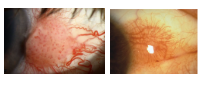 <p>What is the most likely diagnosis ?</p>