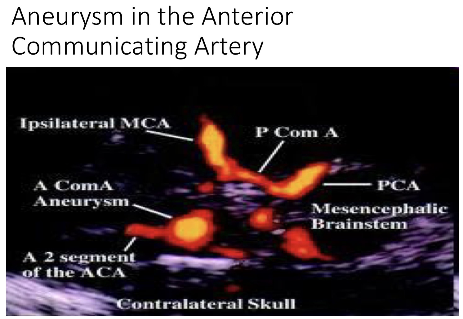<ul><li><p>Short vessel that connected the anterior cerebral arteries (A1-A2)</p></li><li><p>Most common site for intracranial aneurysms</p></li><li><p>Most common collateral pathway between R and L hemispheres</p></li></ul><p></p>