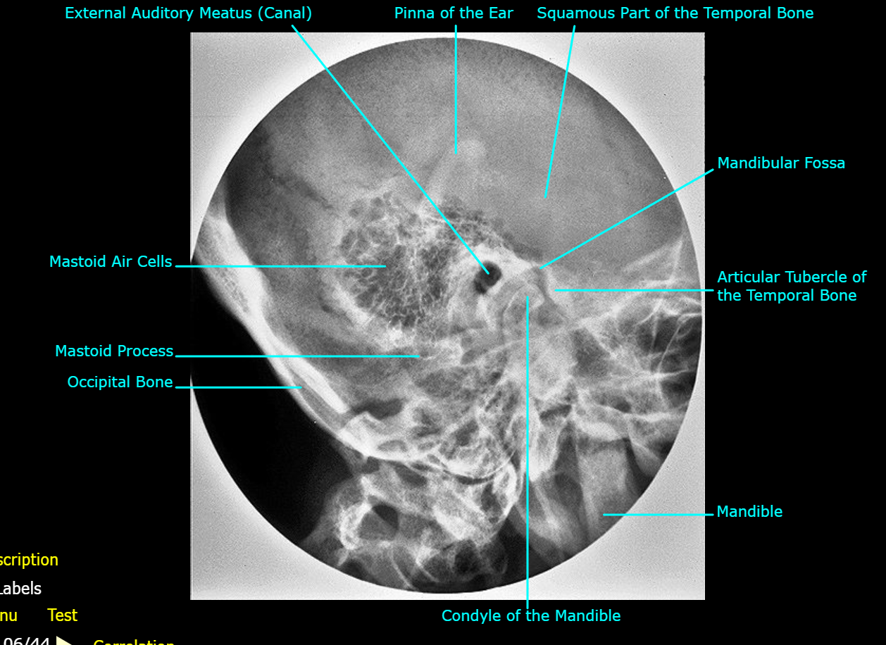<ol><li><p>Mastoid Air Cells</p></li><li><p>Mastoid Process</p></li><li><p>Occipital Bone</p></li><li><p>Condyle of the Mandible</p></li><li><p>Mandible</p></li><li><p>Articular Tubercle of the Temporal Bone</p></li><li><p>Mandibular Fossa</p></li><li><p>Squamous part of the Temporal Bone</p></li><li><p>Pinna of the Ear</p></li><li><p>External Auditory Meatus</p></li></ol><p></p>