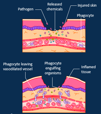 <p><span>Inflammation is a protective response but causes local tissue swelling, erythema, heat and pain. </span></p><p style="text-align: left;"><span><strong>1. Vasodilation and capillary permeability.</strong></span></p><p style="text-align: left;"><span> Mast cells release histamine and heparin.</span></p><p style="text-align: left;"><span><strong>2. Migration of phagocytes.</strong></span></p><p style="text-align: left;"><span> Neutrophils engulf pathogens and secrete cytokines which attract monocytes (transform into macrophages) by chemotaxis. Fibrin network prevent spread of microbes. </span></p><p style="text-align: left;"><span><strong>3. Tissue regeneration.</strong></span></p><p style="text-align: left;"><span> Healing and fibroblasts secrete collagen to form a scar.</span></p><p style="text-align: left;"></p><ul><li><p style="text-align: left;"><span>C-Reactive Protein (CRP) is a non-specific biochemical maker of inflammation.</span></p></li><li><p style="text-align: left;"><span>Inflammatory process stimulates the adaptive immune system.</span></p></li></ul><p></p>