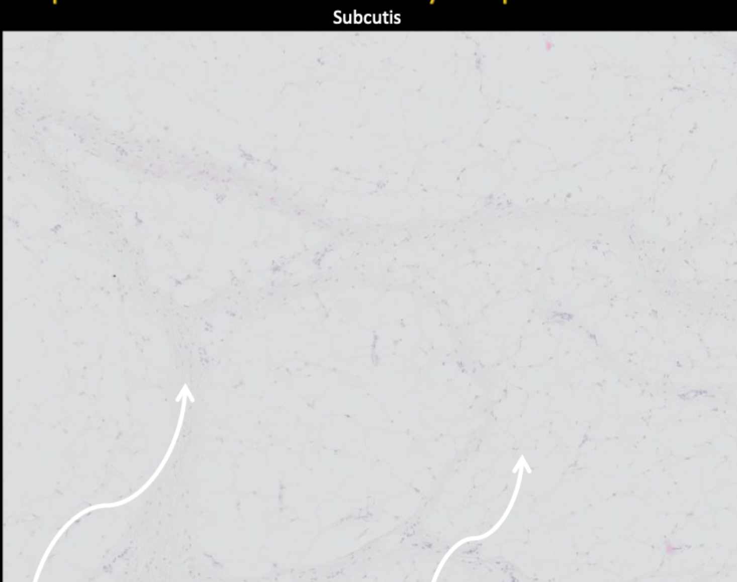 <p>Hvad ses i subcutis? </p>