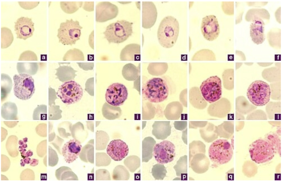 <p>-Retics inected (large RBCs)</p><p>-Ring forms >1/3 size of RBC</p><p>-Mature trophs more compact than P. vivax</p><ul><li><p>Comet forms</p></li></ul><p>-Schizont has 6-14 merozoites</p><p>-Gametocytes are large and oval</p><p>-Schuffner’s dots</p><p></p>