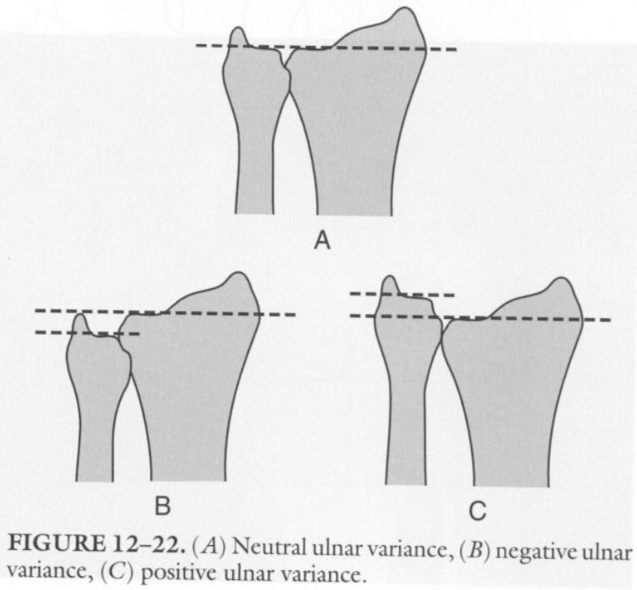<p>The ulna is TOO LONG</p><p>-possible TFCC Impingement</p><p>---causes pain when loading wrist &amp; during ulnar deviation</p>