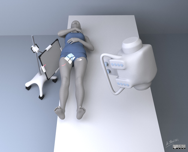 <p>15 degrees POSTERIOR and perpendicular to the femoral neck?</p>